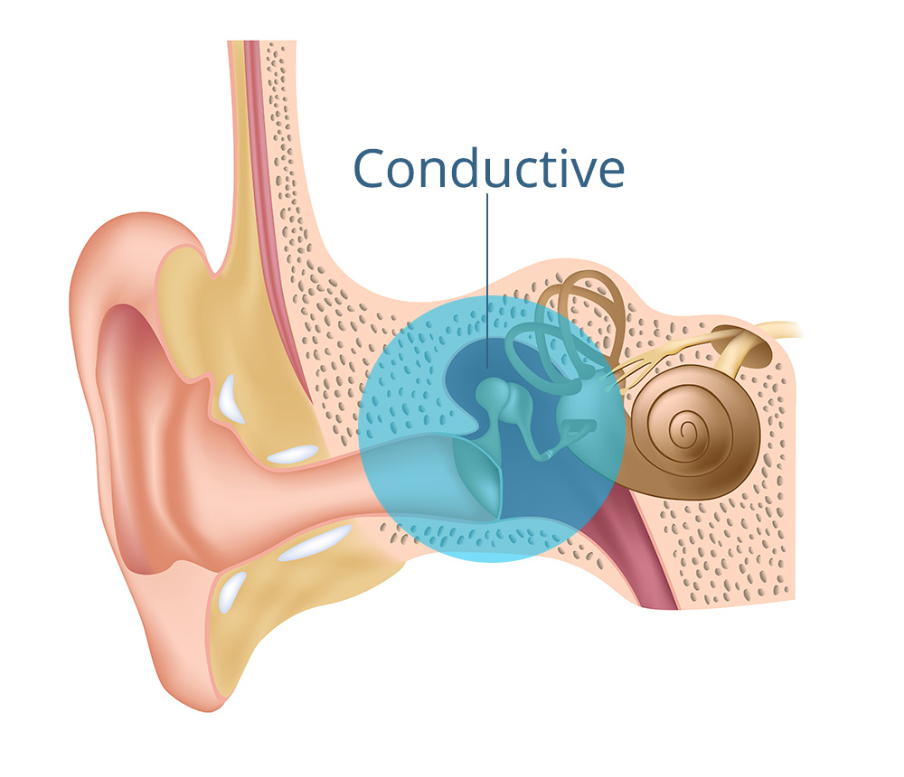 ConductiveHearingLoss