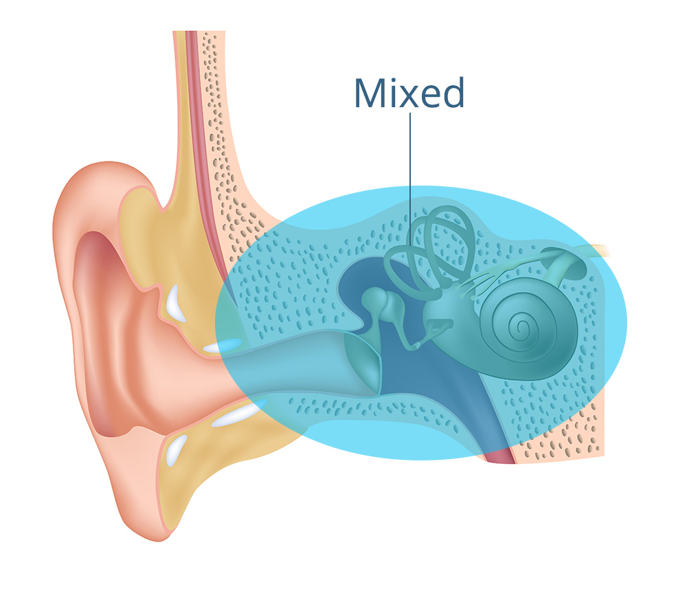 MixedHearingLoss