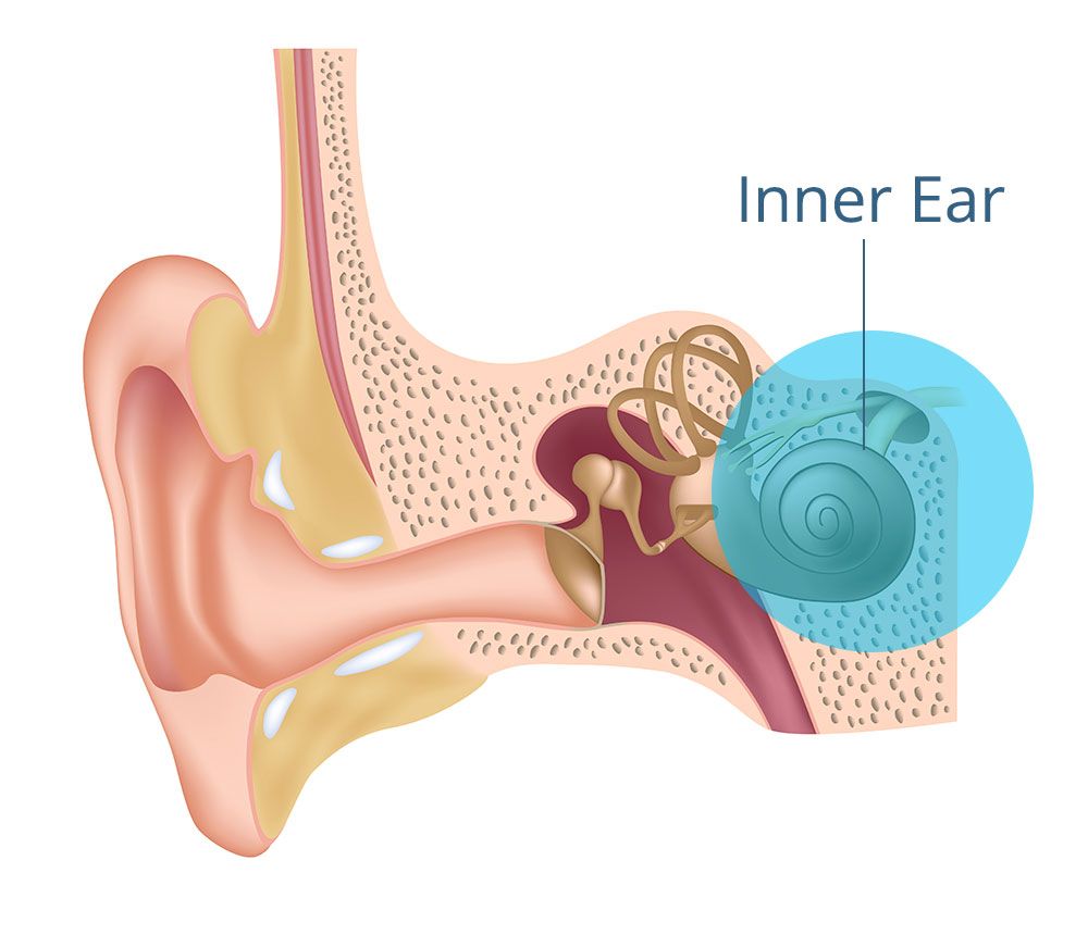 SensorHearingLoss